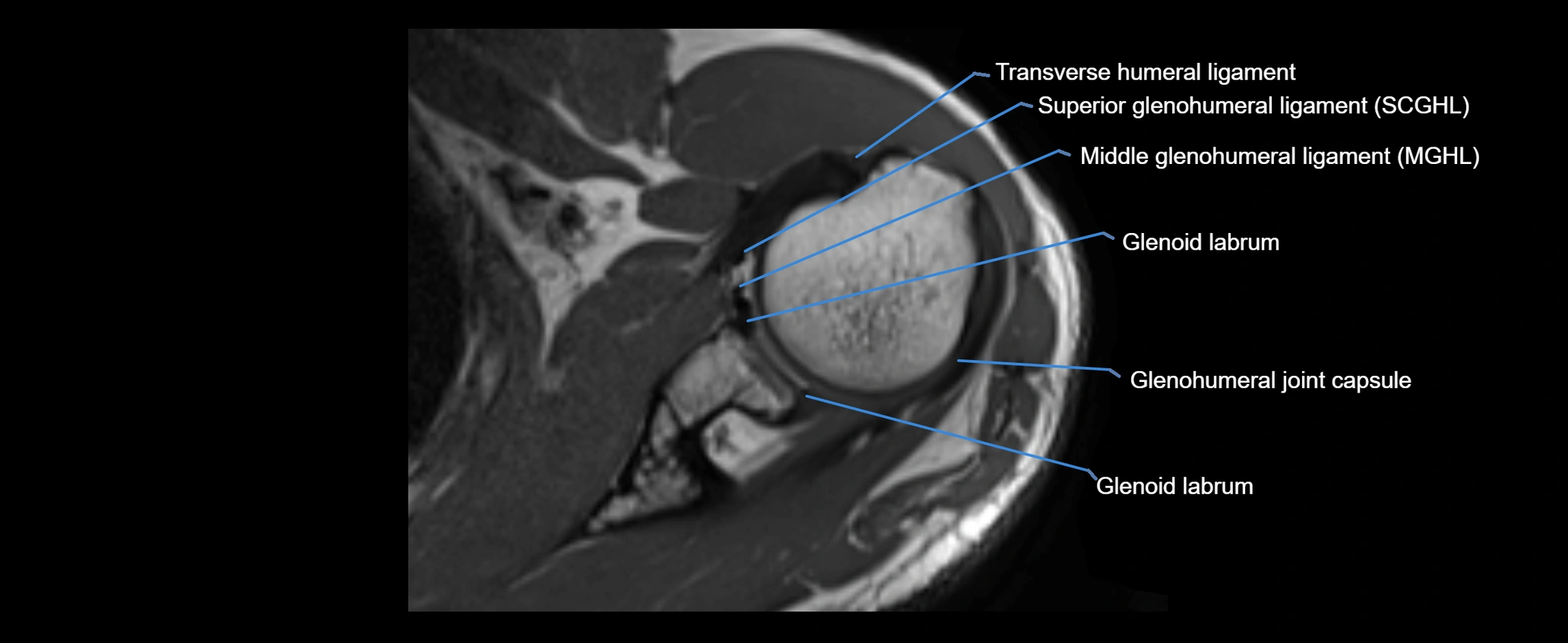 shoulder ligaments axial 3d 3t mri image-img-00005-00055.webp
